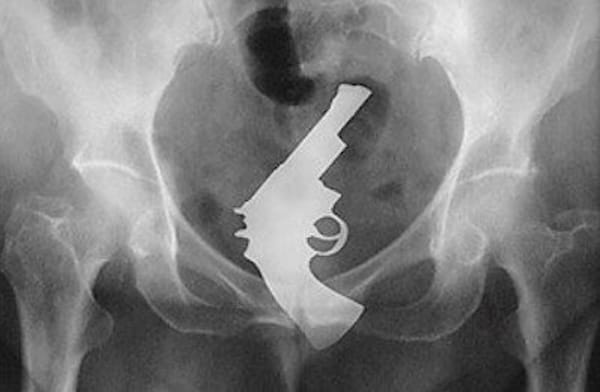 X-ray image showing a gun-shaped object inside a human pelvis.